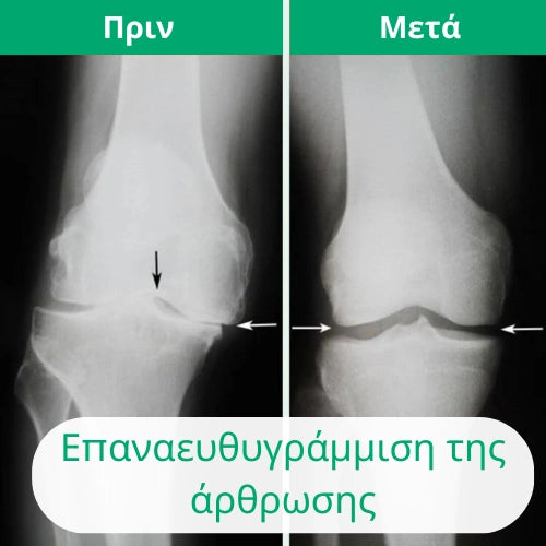 OrthoKnee™ -  Μακροχρόνια ανακούφιση από την αρθρίτιδα και τους αρθρικούς πόνους