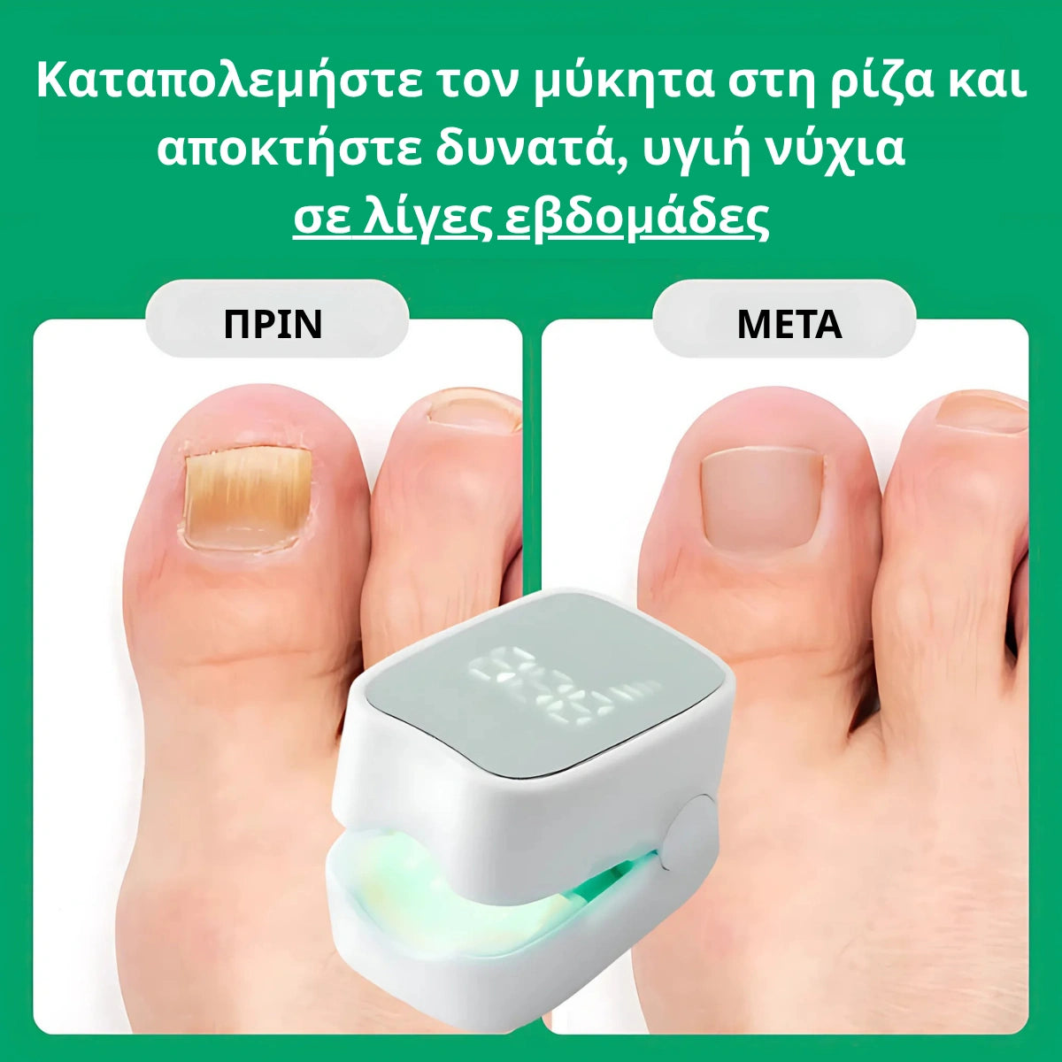 Varnexil™ - Εξαλείψτε οριστικά τους μύκητες των νυχιών, ακόμα και τους πιο επίμονους