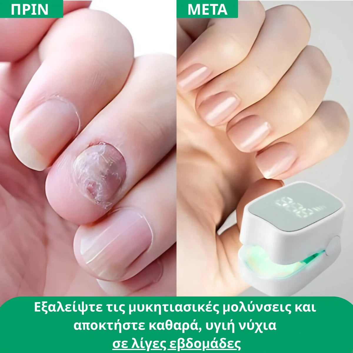 Varnexil™ - Εξαλείψτε οριστικά τους μύκητες των νυχιών, ακόμα και τους πιο επίμονους